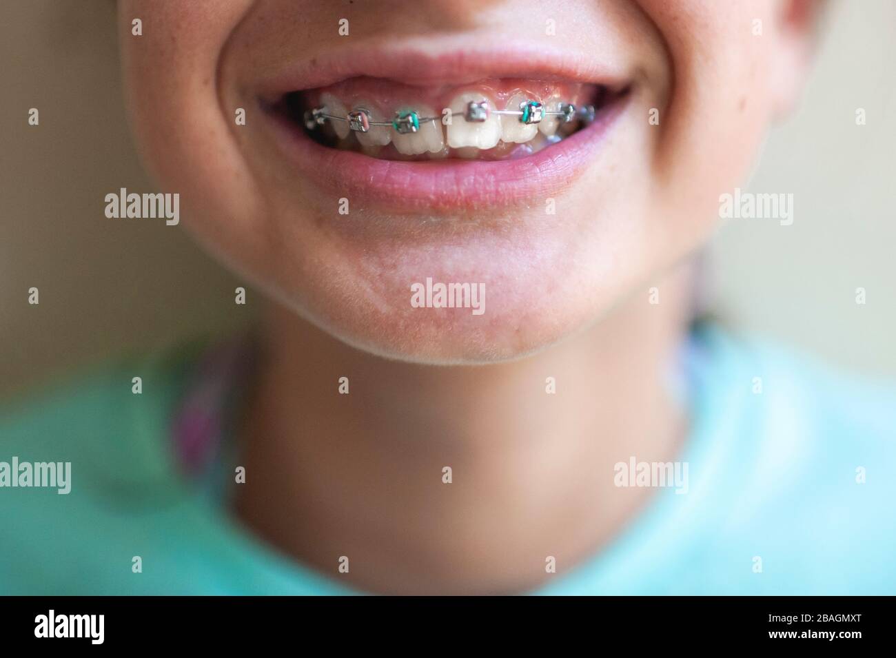 Girl 11 13 with braces hires stock photography and images Alamy