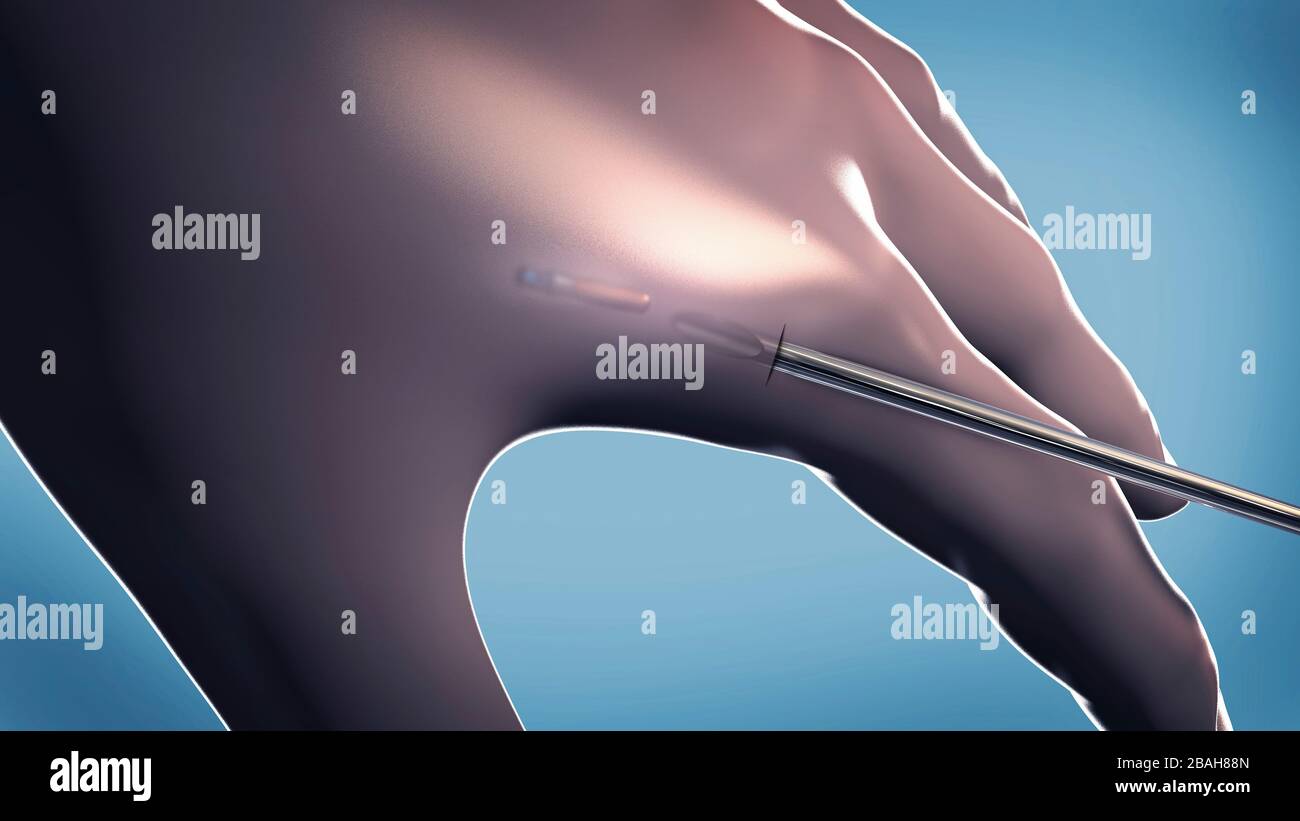 Microchip For Humans Microchip implanted in human hand, illustration Stock Photo - Alamy