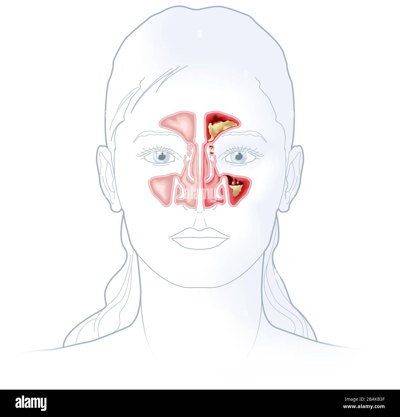 Illustration showing healthy sinus and sinusitis with inflamed lining, obstructed sinus opening, adenoid and excess mucus Stock Photo