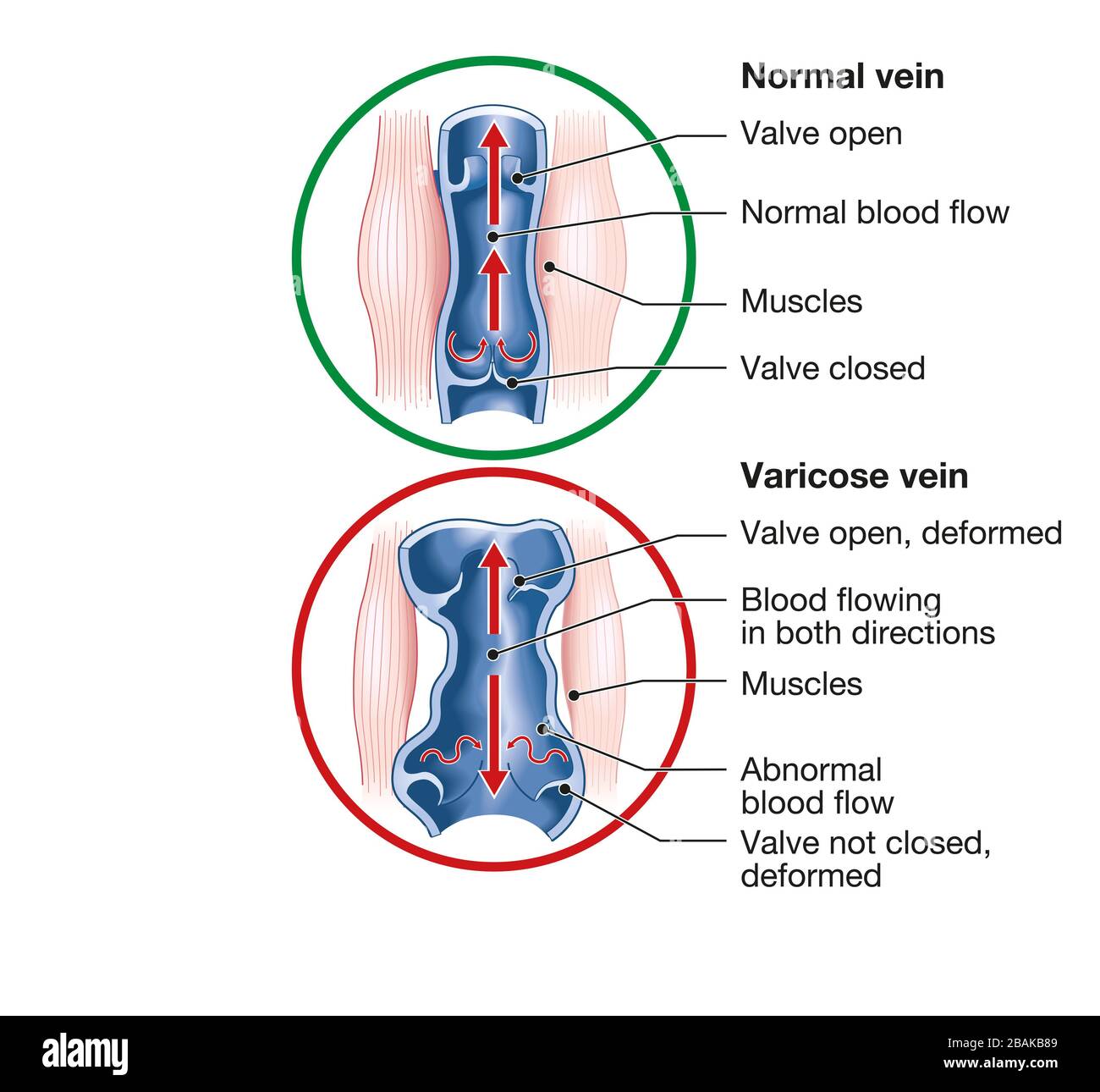 Illustration showing varicose veins and normal veins Stock Photo Alamy