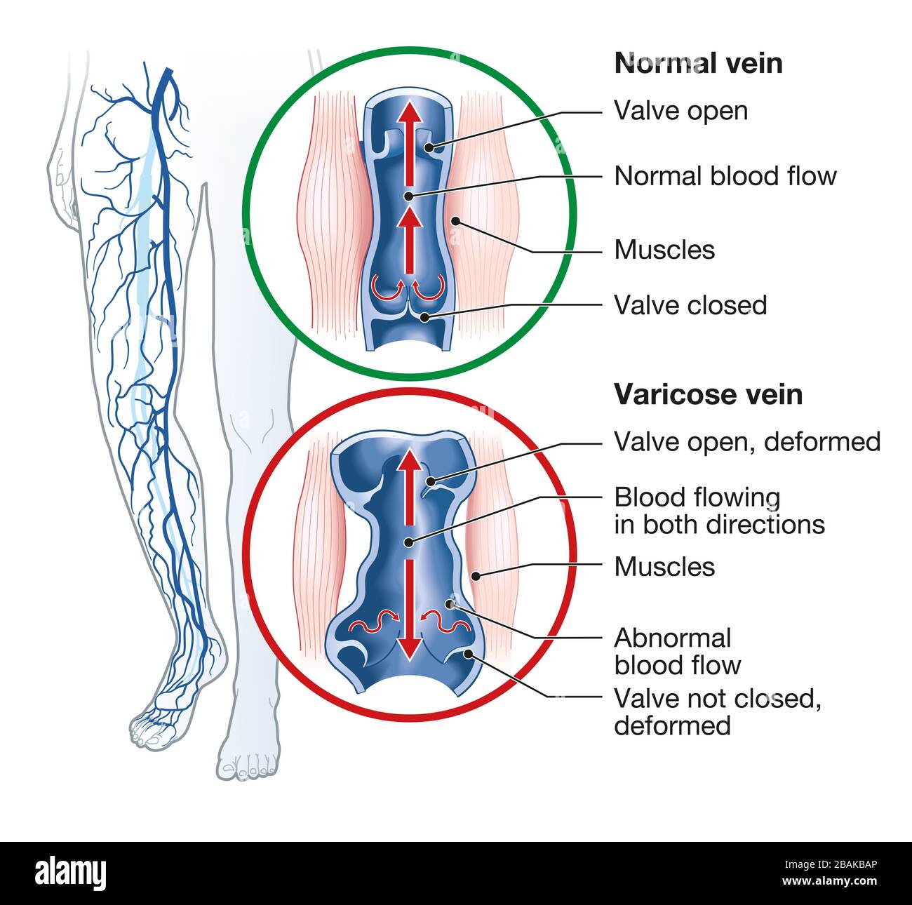 Illustration showing varicose veins and normal veins Stock Photo