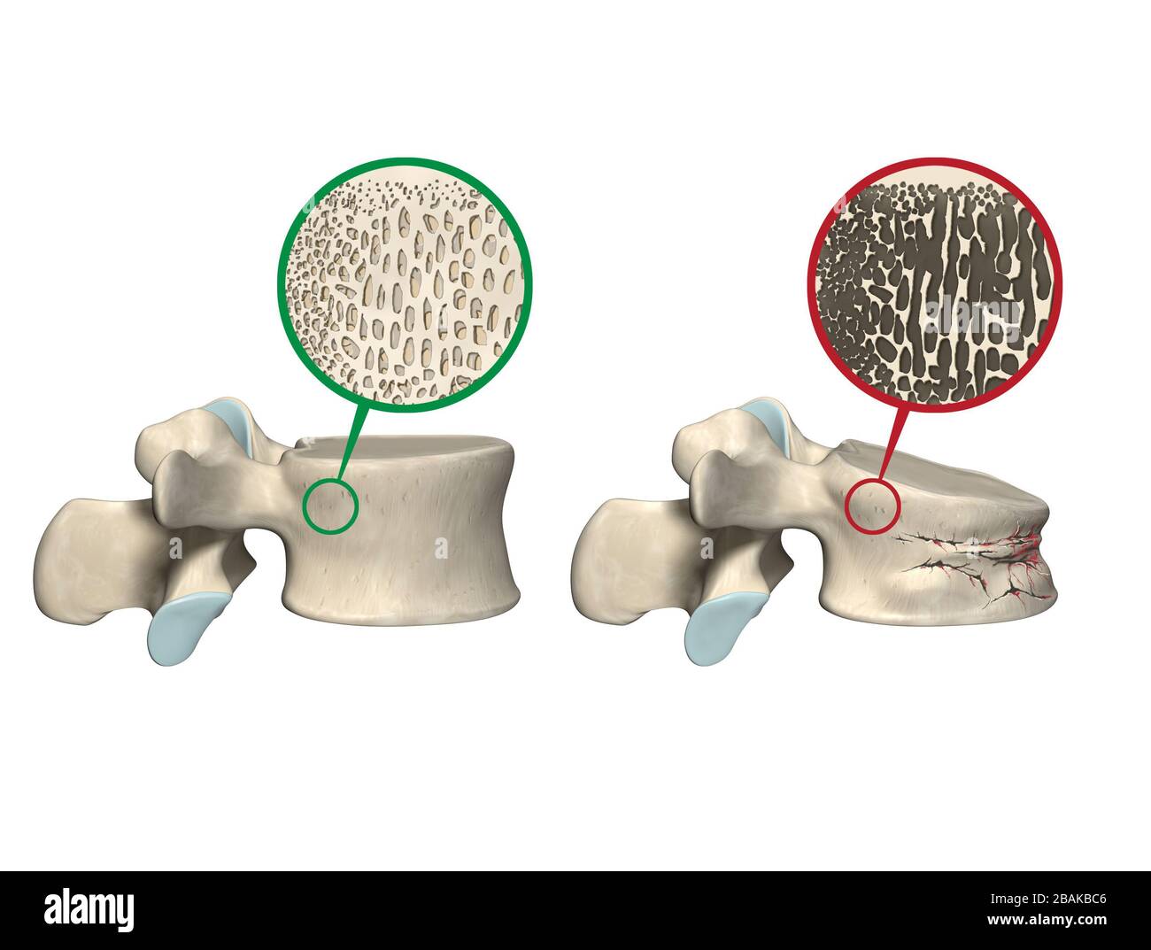 left: healthy vertebral body and normal bone matrix,  right: vertebral body with osteoporosis and crush fracture, 3D illustration Stock Photo