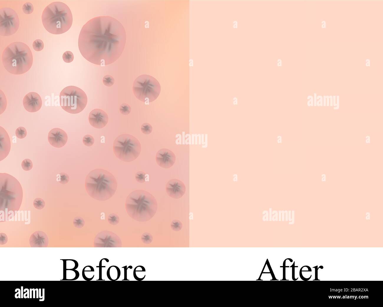 Texture with acne scars and acne. Before After scar cysts. Skin