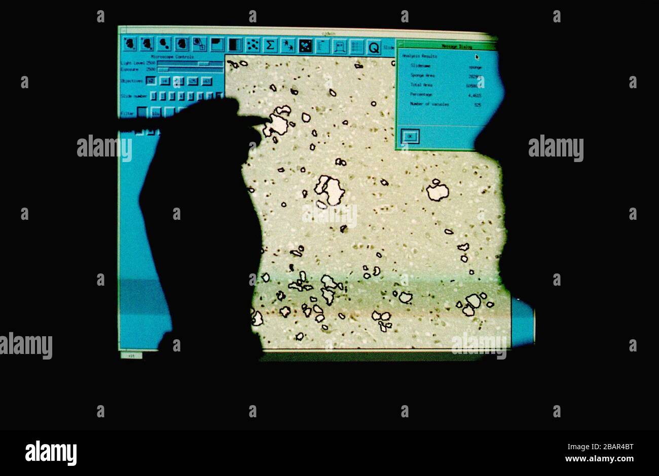 A Scientist examining a screen with a segment of brain displayed showing the incidence of CJD on a human brain (indicated with black rings round the white cells). The incidence of Creutzfeldt-Jakob disease (CJD) has been monitored in the UK by the National CJD surveillance unit based at the Western General Hospital in Edinburgh, Scotland. The unit brought together a team of clinical neurologists, neuropathologists and scientists specialising in the investigation of this disease Stock Photo