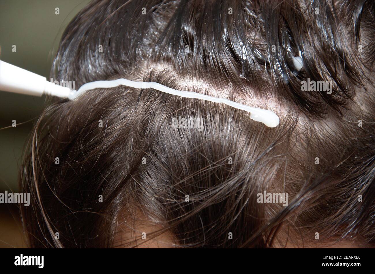 Head lice and nits treatment of infestation with medicated shampoo. Stock Photo