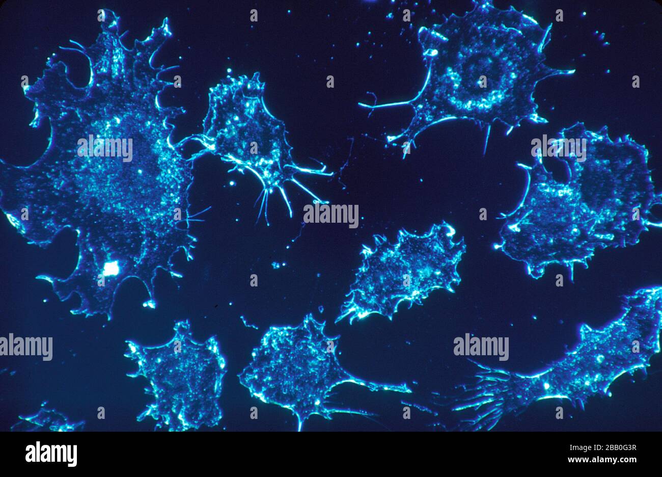 'English:  Title Cancer Cells Description Cancer cells in culture from human connective tissue, illuminated by darkfield amplified contrast, at a magnification of 500x. These cells can be compared to normal cells on: See also http://visuals.nci.nih.gov/details.cfm?imageid=2304. Topics/Categories  Cells or Tissue, Abnormal Cells or Tissue Type Color, Photo Source National Cancer Institute; November 1987; This image was released by the National Cancer Institute, an agency part of the National Institutes of Health, with the ID 2306 (image) (next). This tag does not indicate the copyright status o Stock Photo