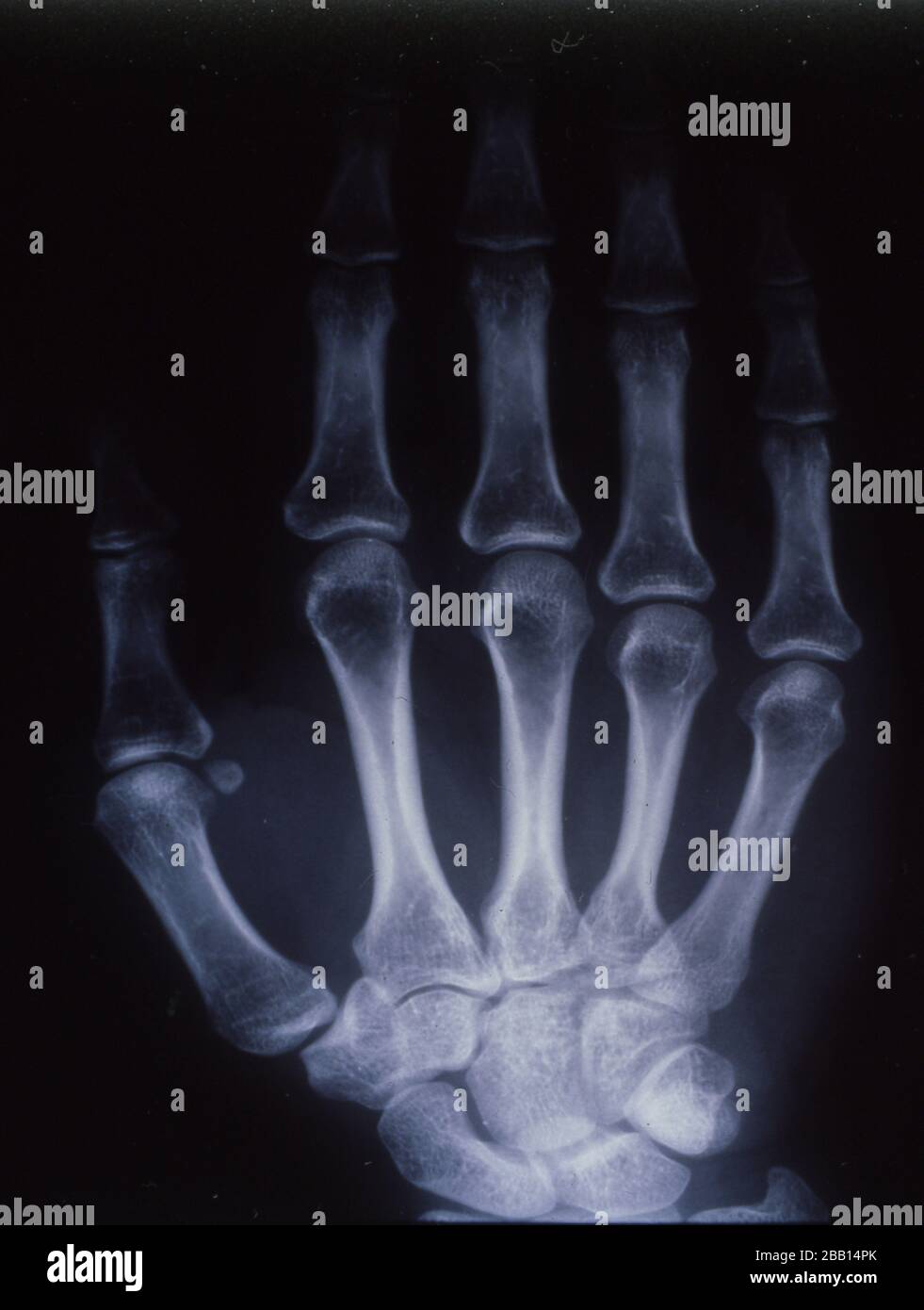 X-ray image, man, hand with bones and joints Stock Photo - Alamy