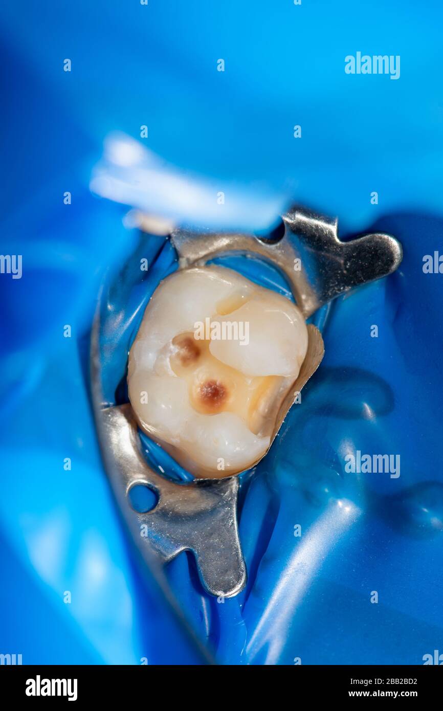 Dental caries. Filling with dental composite photopolymer material