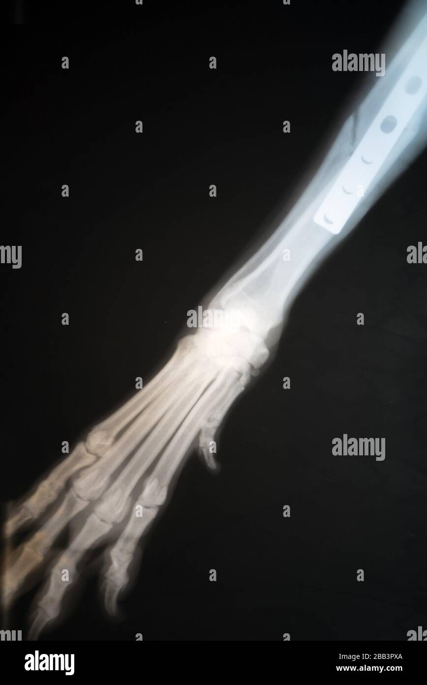 Broken bone x ray hires stock photography and images Alamy
