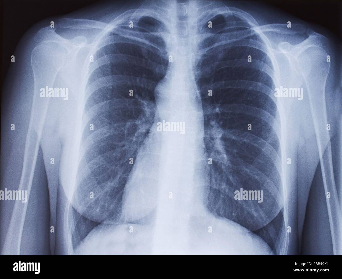 Chest x-ray, lungs infection, pulmorany disease, covid-19 new coronavirus illustration Stock Photo