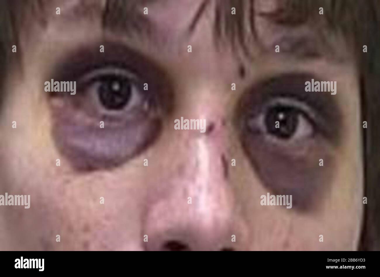 Ecchymosis hi-res stock photography and images - Alamy