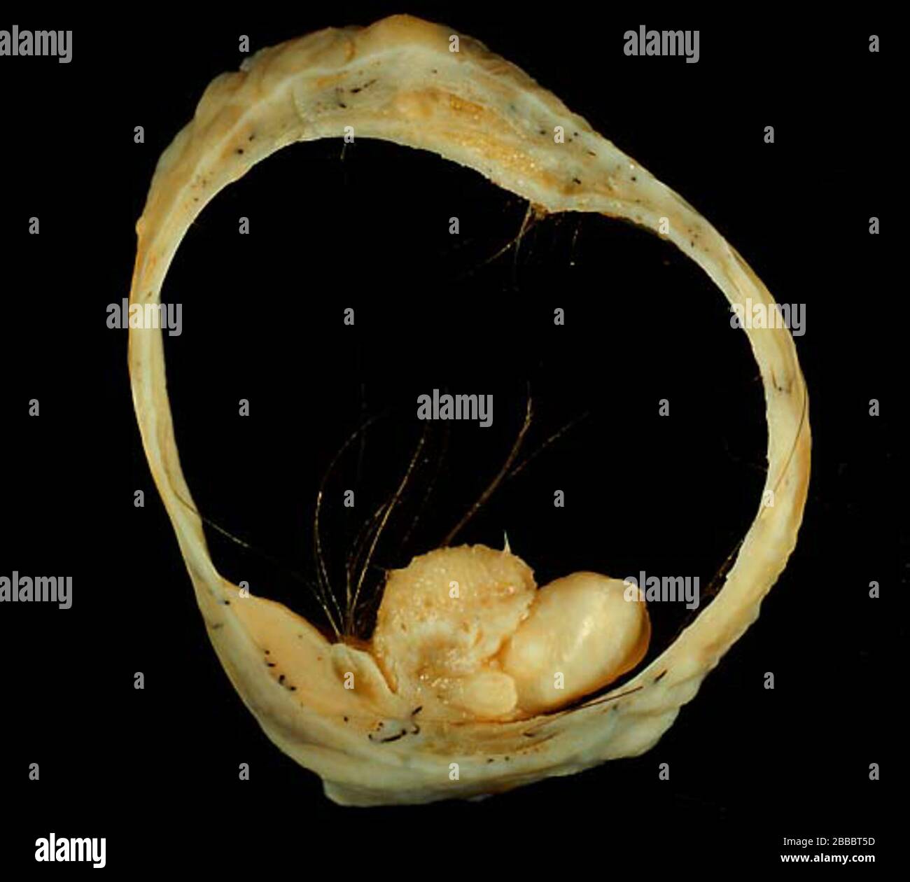 Teratoma tumor hi-res stock photography and images - Alamy Teratoma tumor hi-res stock photography and images - Alamy