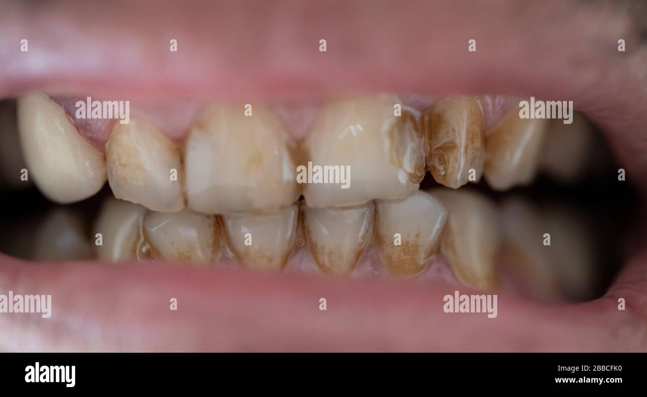 Tooth Decay Cavity High Resolution Stock Photography and Images Alamy