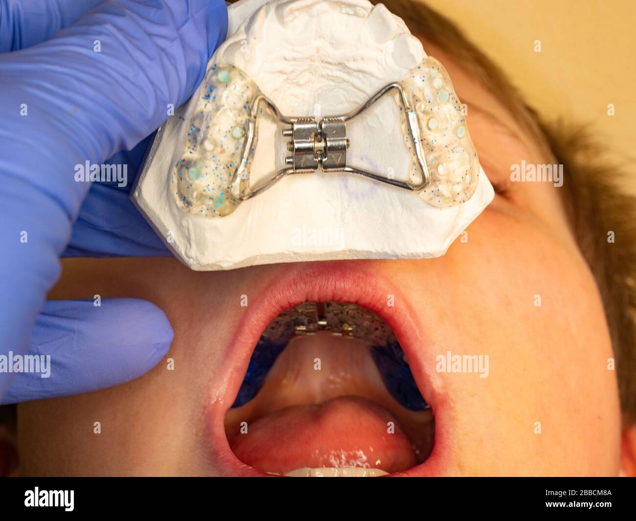 Dental braces. Teeth cast and child jaw with braces installed. To align
