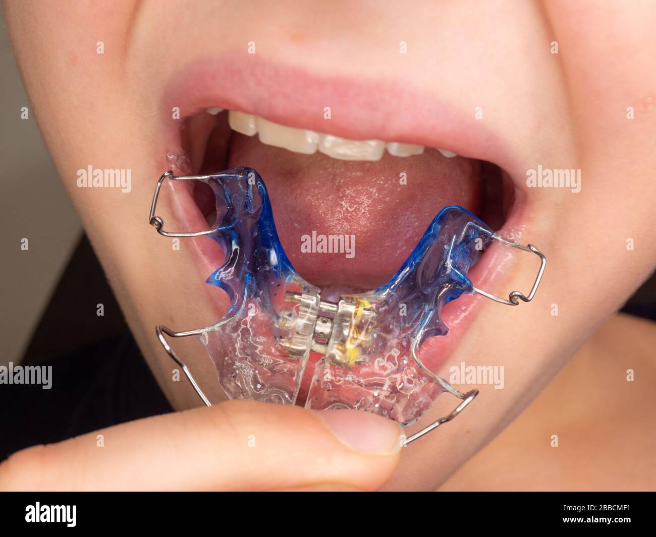 Funny smile teenager wearing orthodontic braces and showing tongue