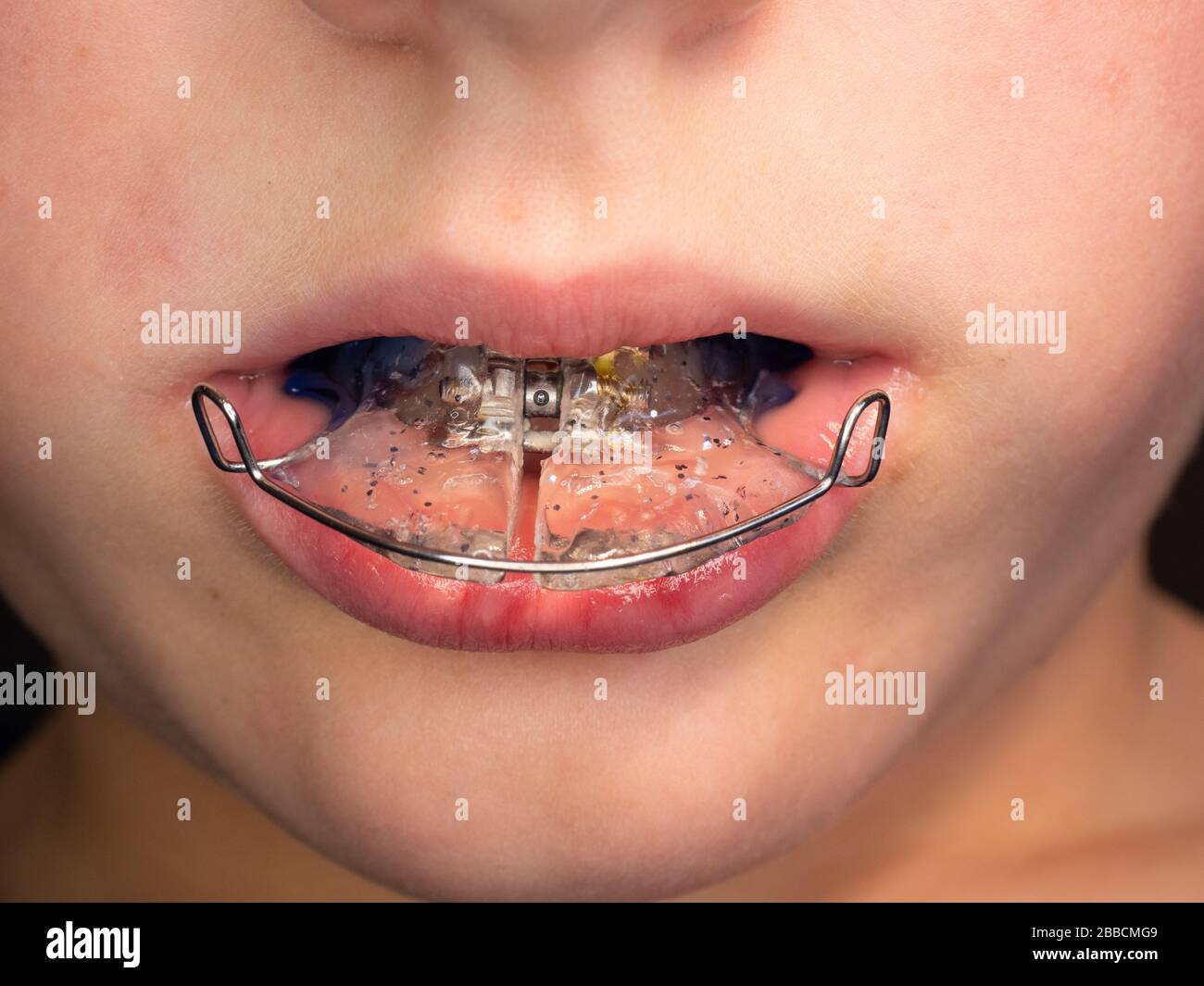 Teenage boy wearing orthodontic braces and showing tongue. Teeth with