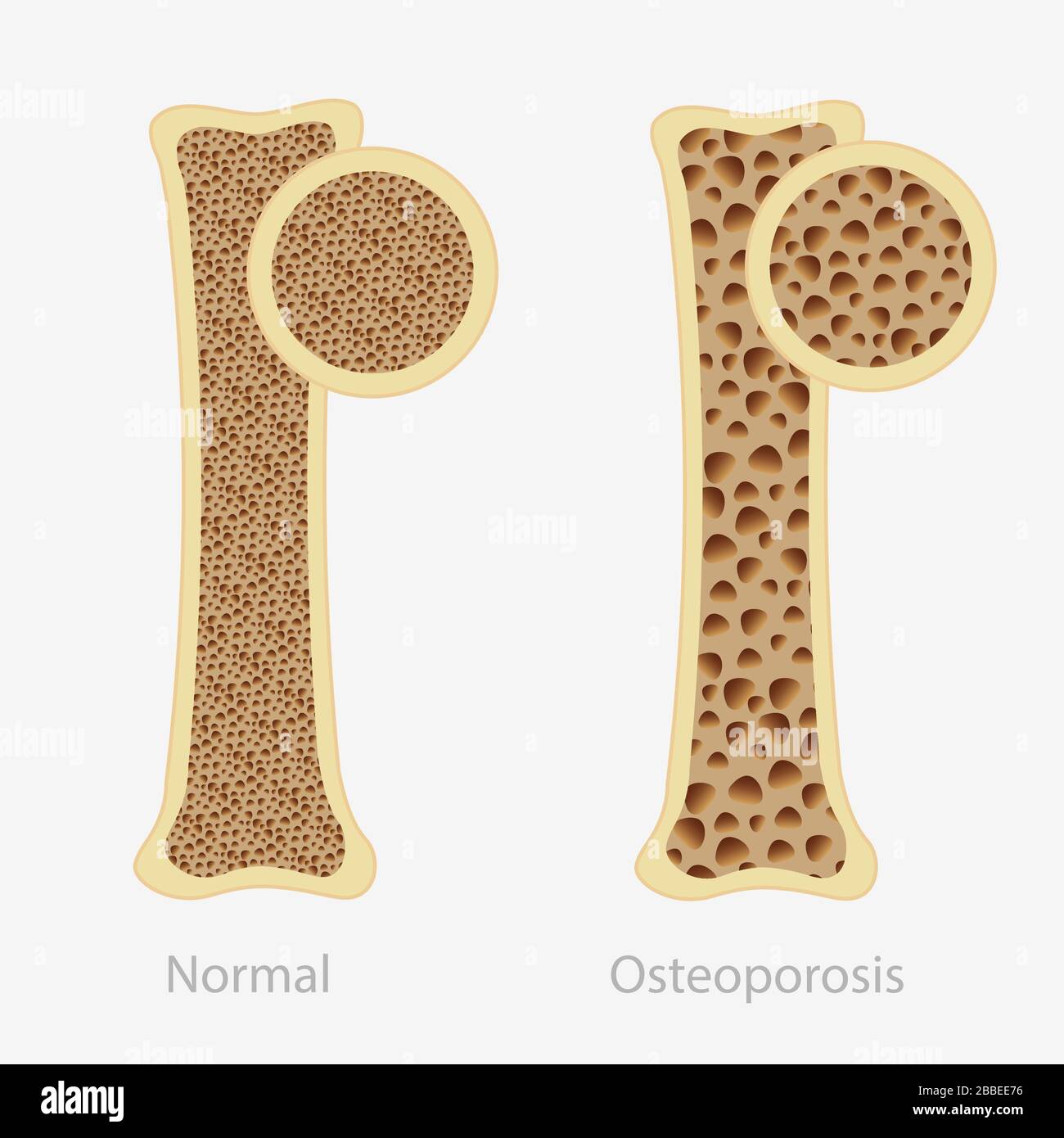 Cartoon human osteoporosis and normal healthy bone vector flat illustration  Stock Vector Image & Art - Alamy