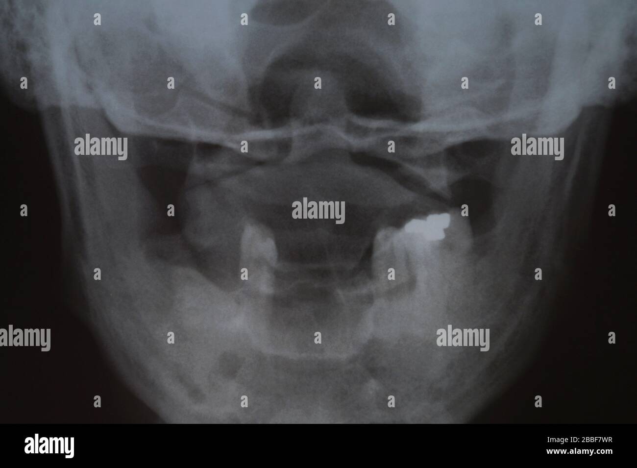 Bone loss hires stock photography and images Alamy