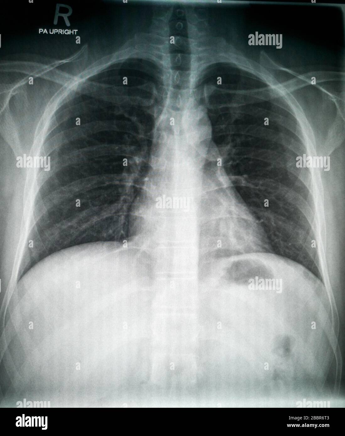 Chest X-Ray of Normal male patient high quality image showing normal anatomy Stock Photo