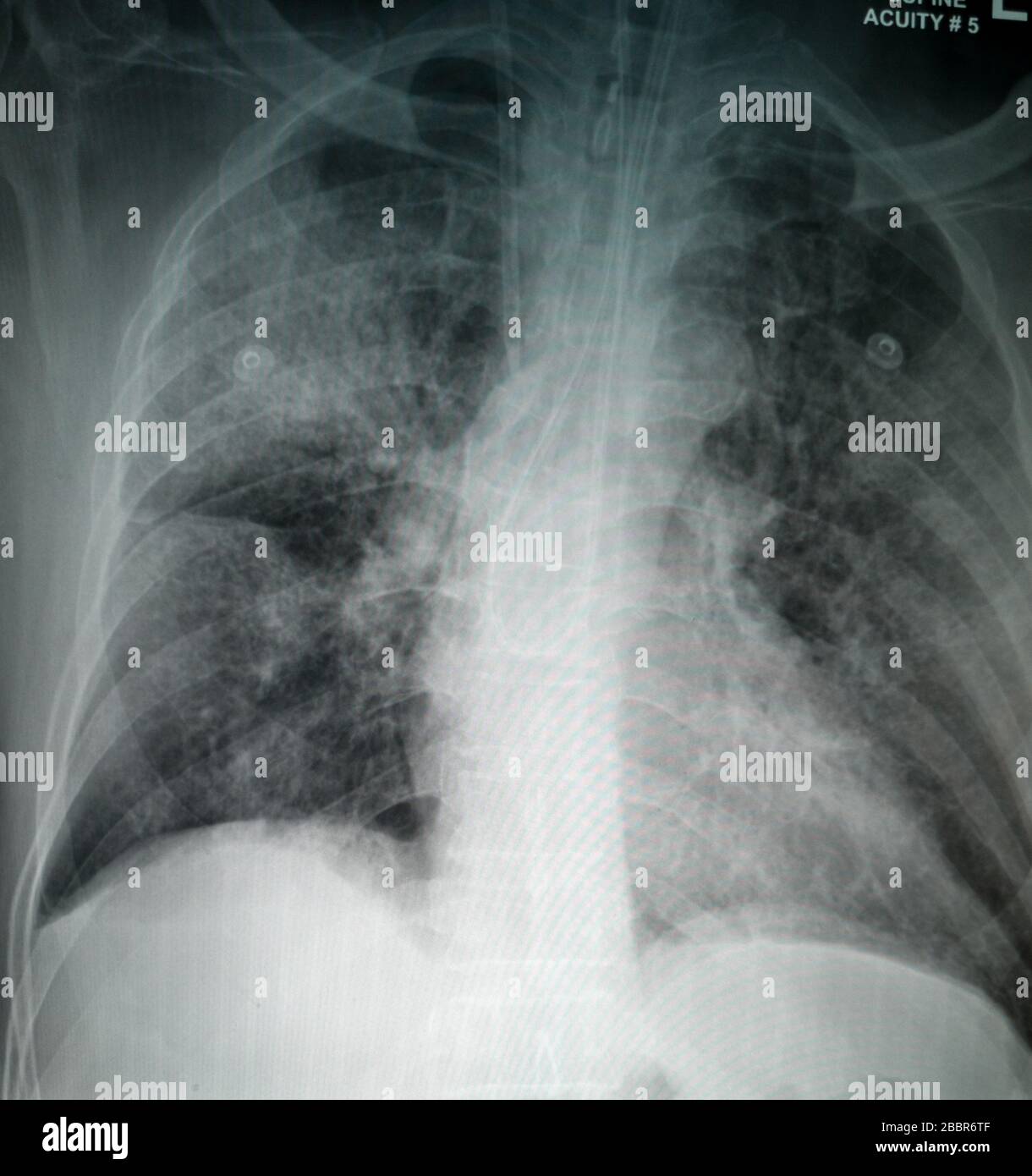 Chest X-Ray of suspected Corona virus patient high quality image showing changes in the lung due to Covid-19 virus with chest tube Stock Photo