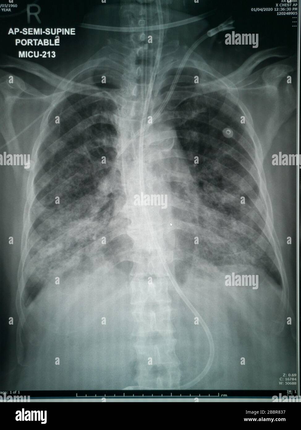 Chest X-Ray of suspected Corona virus patient high quality image showing changes in the lung due to Covid-19 virus with chest tubes Stock Photo