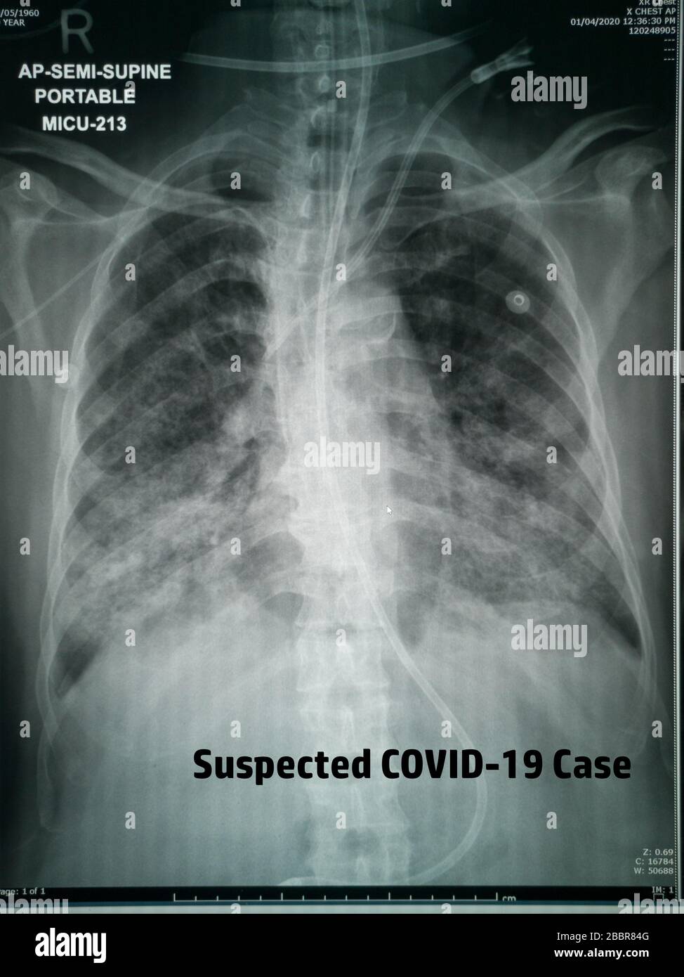 Chest X-Ray of suspected Corona virus patient high quality image showing changes in the lung due to Covid-19 virus with chest tubes Stock Photo