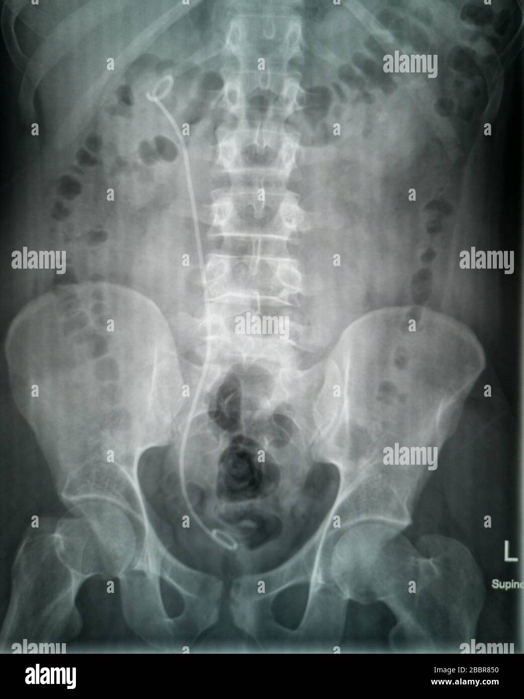 Plain X-Ray of urinary tract (kidney, ureter and urinary bladder) anteroposterior view showing right ureteric stent  (DJ stent) used to treat stones Stock Photo