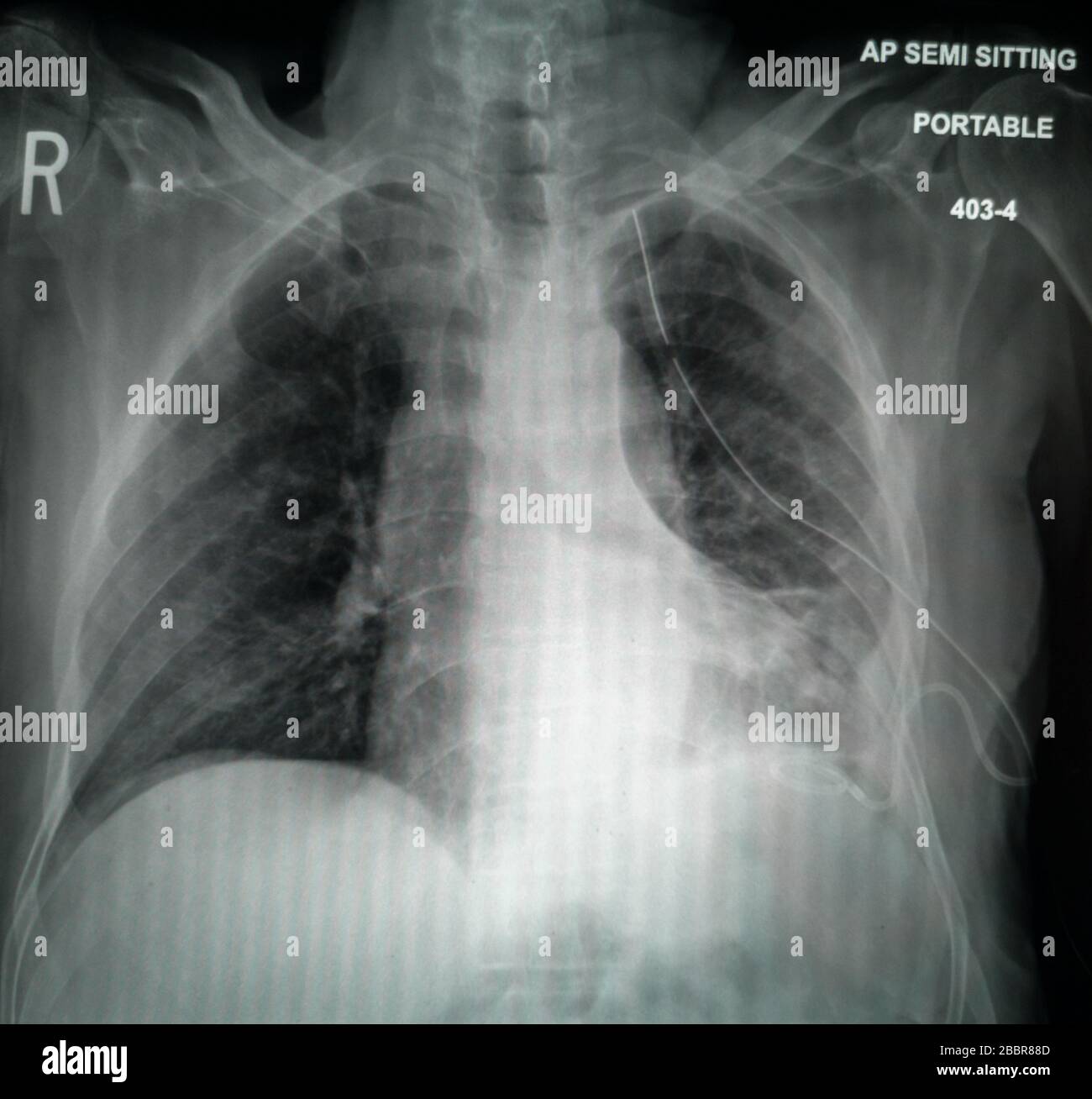 Image ID: 2BBR6TF Chest X-Ray of suspected Corona virus patient high quality image showing changes in the lung due to Covid-19 virus with chest tube Stock Photo