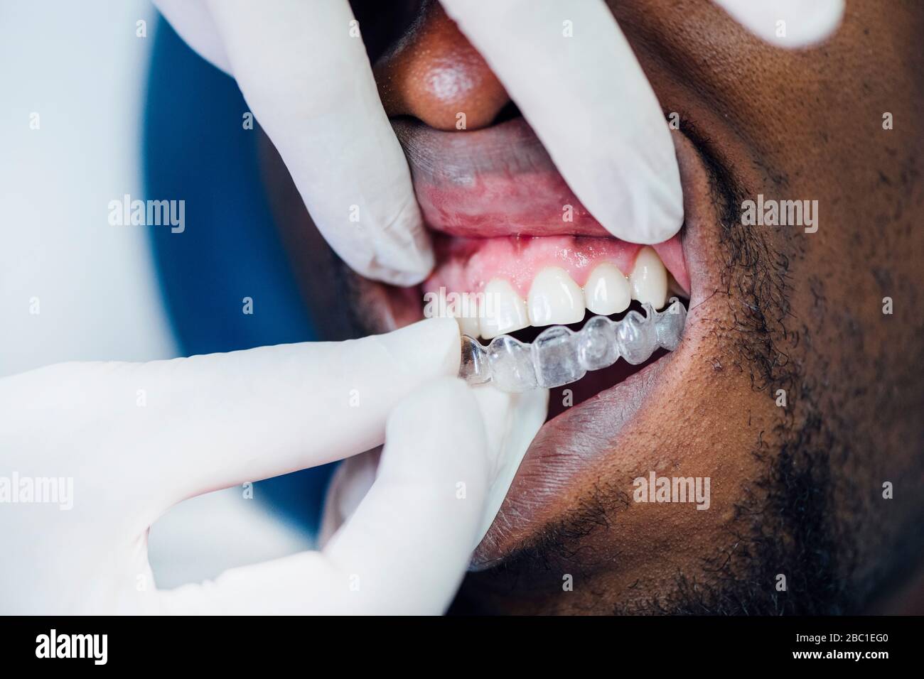 Doctor putting a clear dental aligner to the patient man. Concept ...