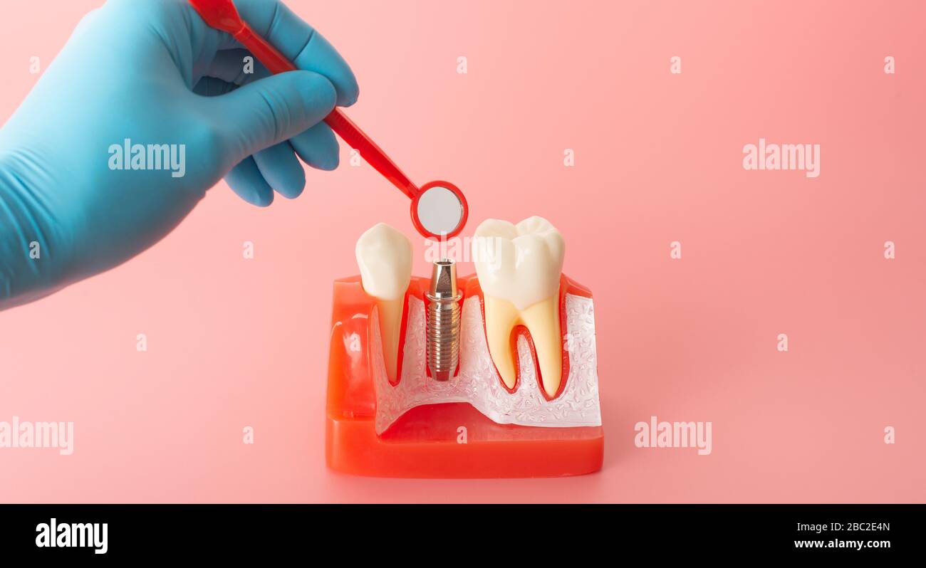 Examples of dental implants made from silicone demonstrate components