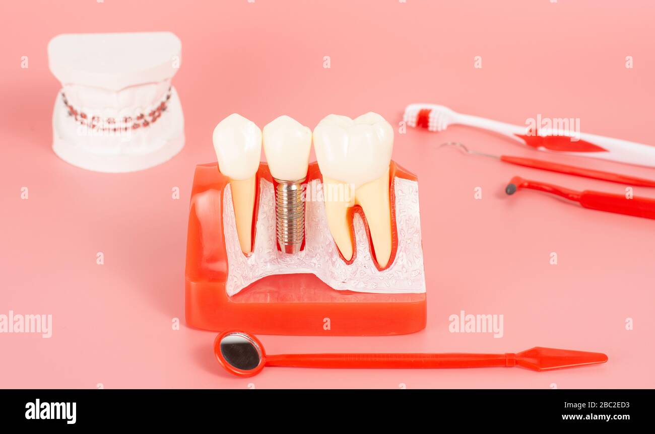 Examples of dental implants made from silicone demonstrate components