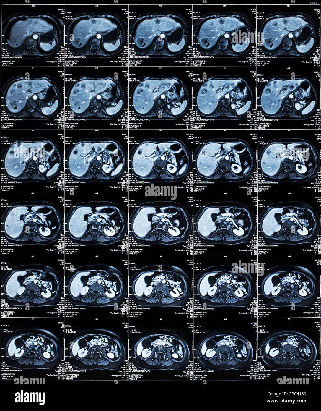 MRI scan of the Human Abdomen organs Stock Photo