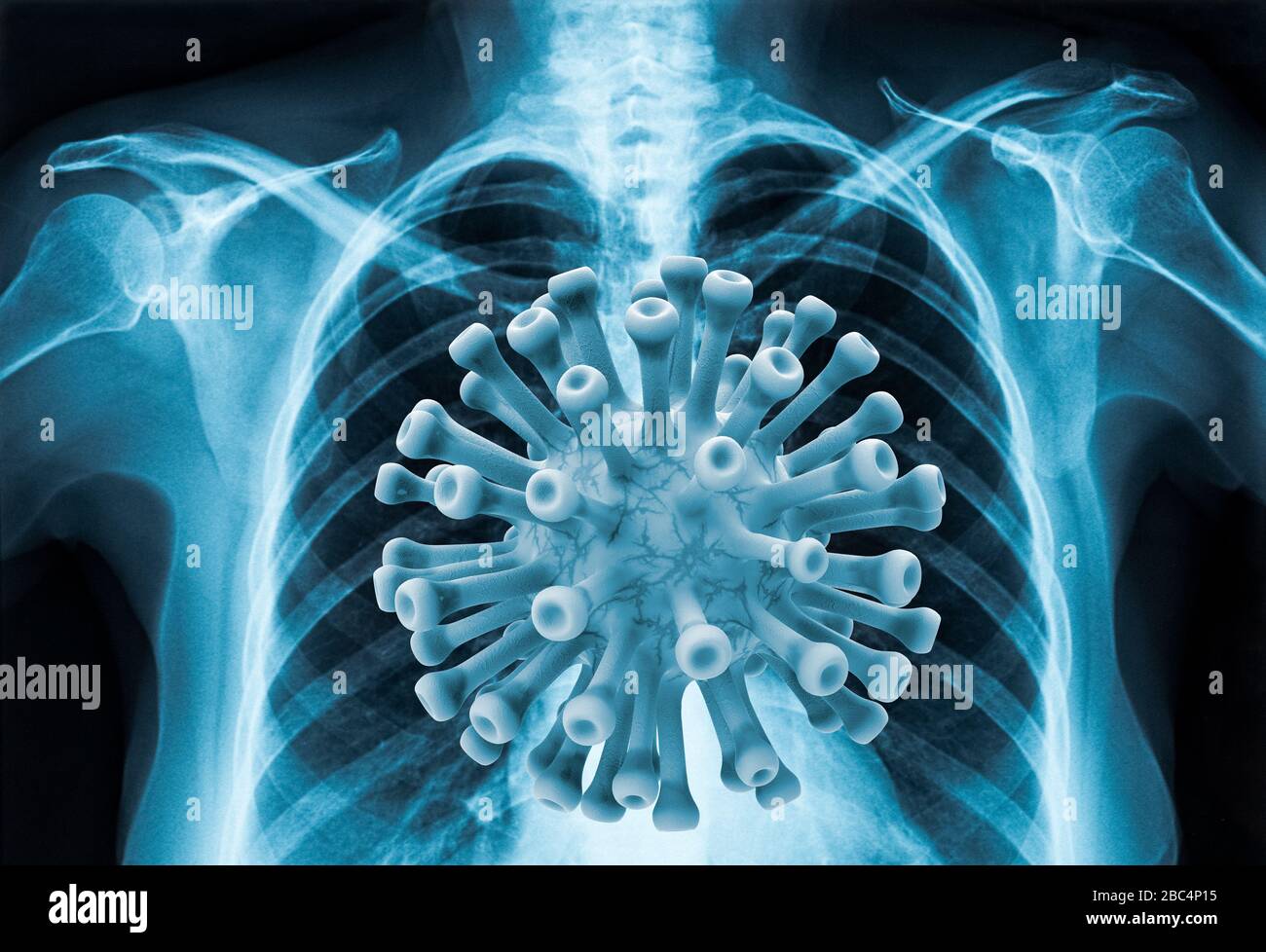 Coronavirus disease COVID-19 virus infection in human lungs, new corona virus infection or COVID (novel Coronavirus 2019 disease,COVID-19,nCoV,SARS-Co Stock Photo