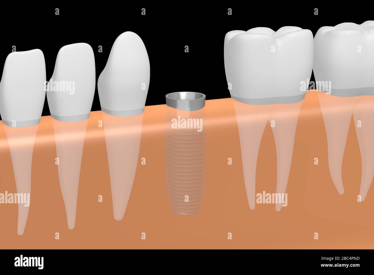 Dental Implant/ Tooth Implant Stock Photo - Alamy