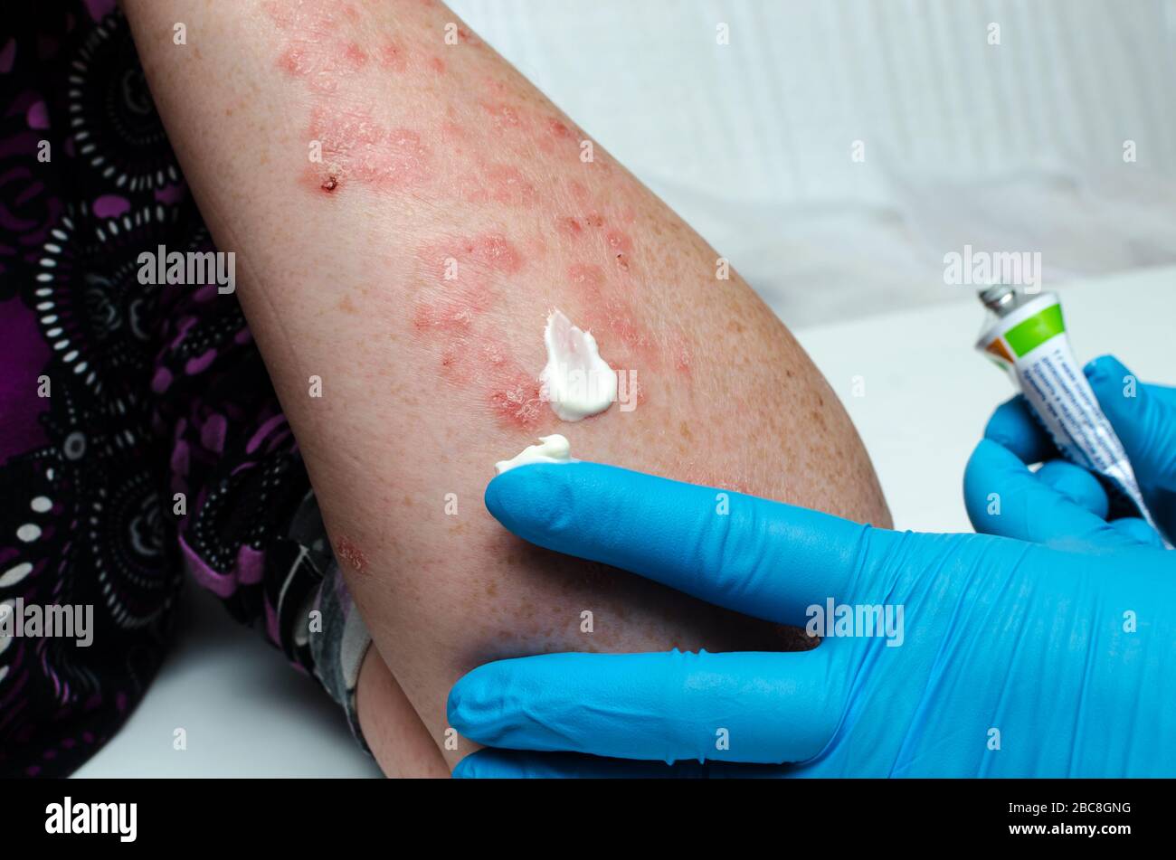 A dermatologist in gloves applies a therapeutic ointment to the affected skin of a patient with psoriasis. Treatment of chronic dermatoses - psoriasis Stock Photo