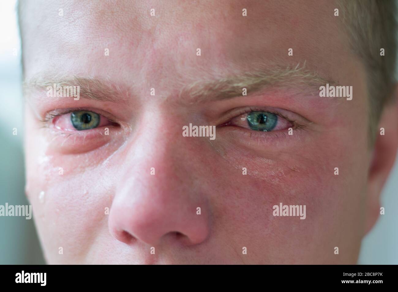 Swollen Face High Resolution Stock Photography and Images Alamy