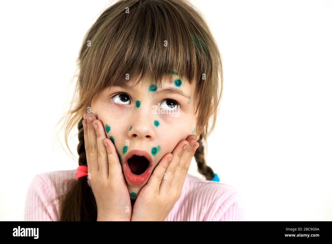 Child girl covered with green rashes on face ill with chickenpox, measles or rubella virus. Stock Photo