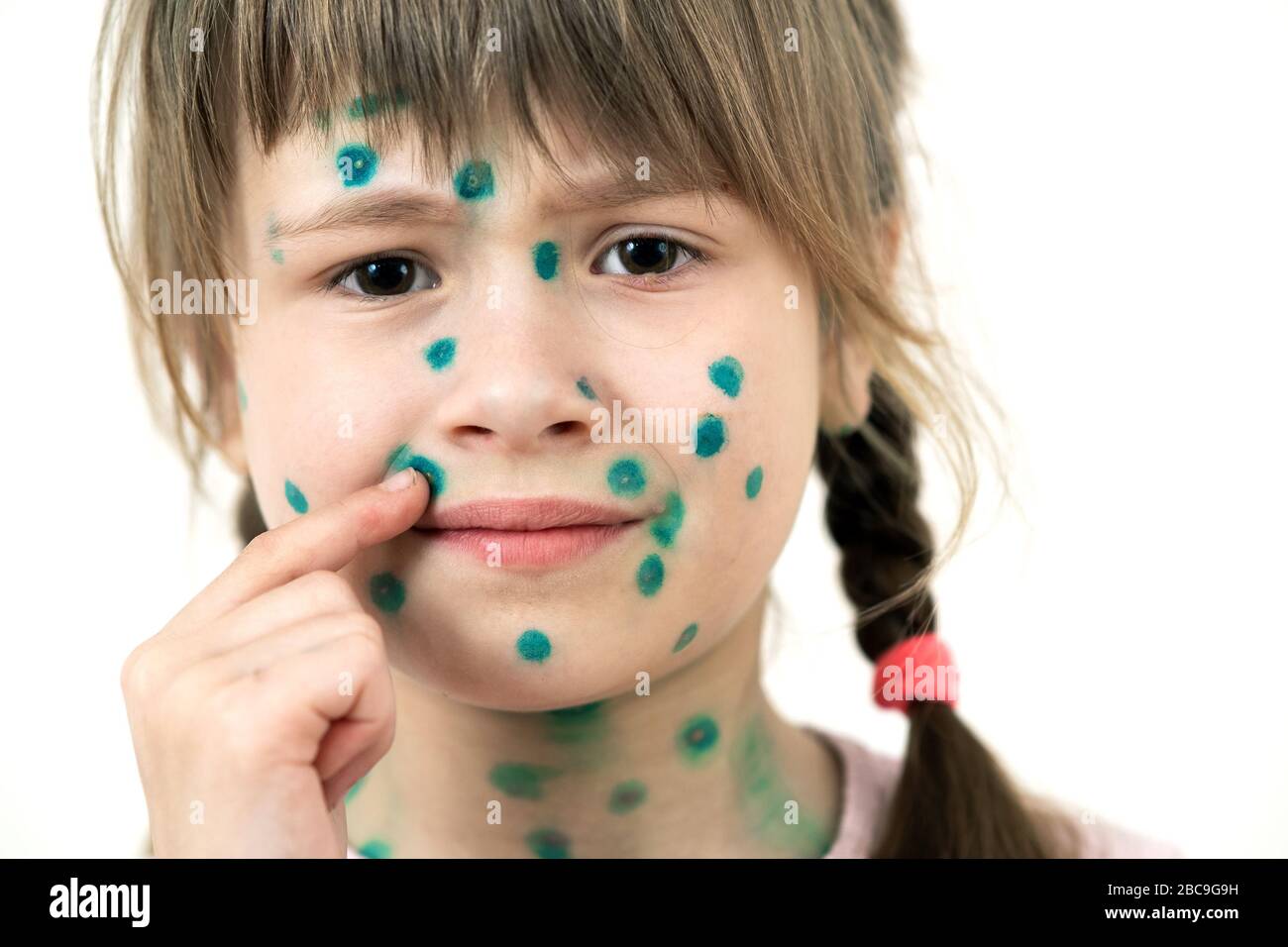 Child girl covered with green rashes on face ill with chickenpox, measles or rubella virus. Stock Photo