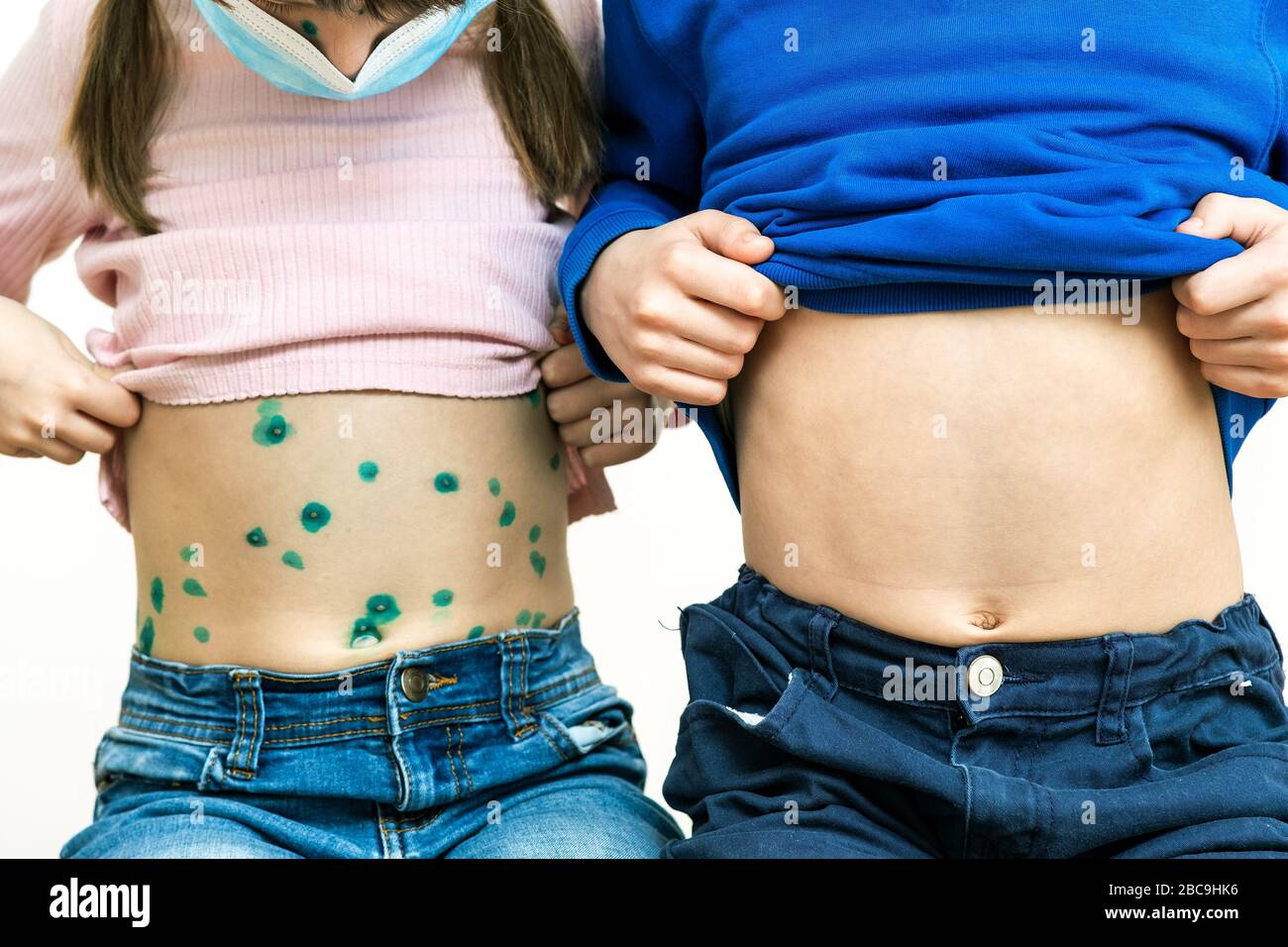 Children covered with green rashes on stomach ill with chickenpox, measles or rubella virus. Stock Photo