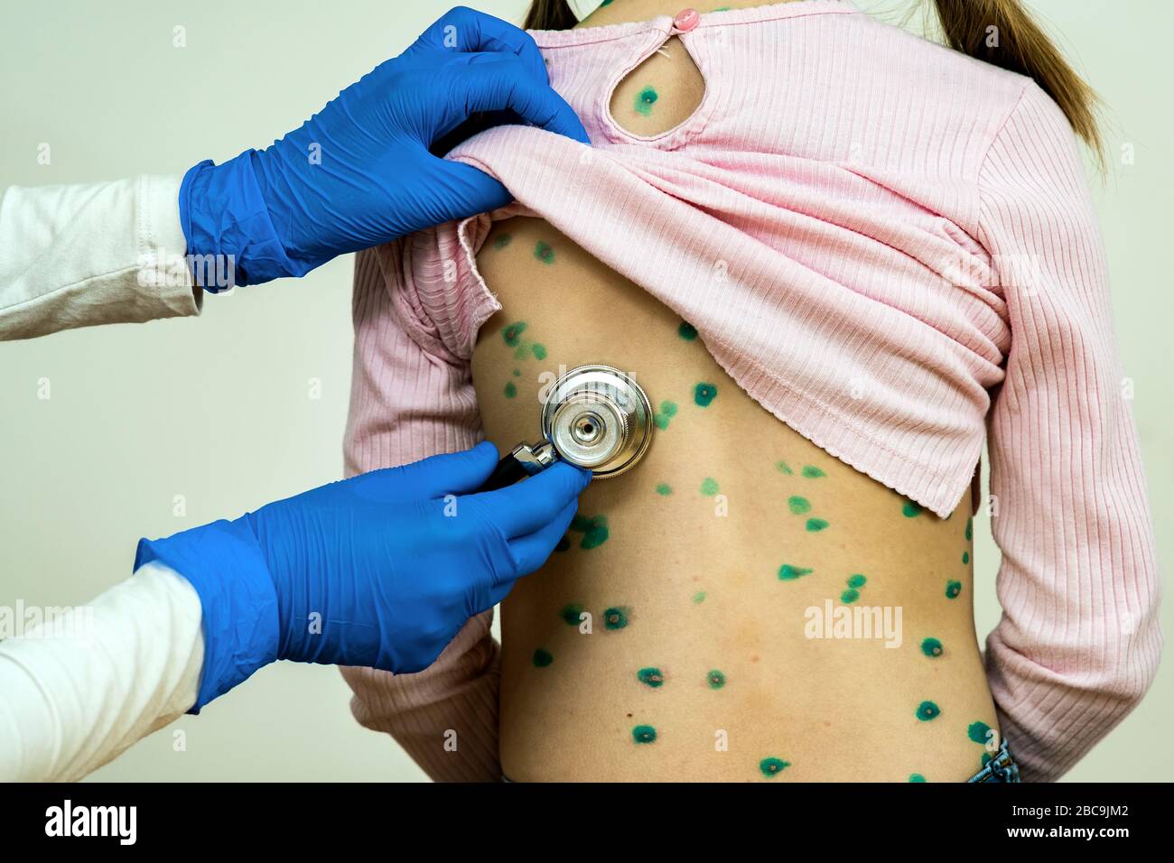 Doctor examining a child with stethoscope covered with green rashes on back ill with chickenpox, measles or rubella virus. Stock Photo