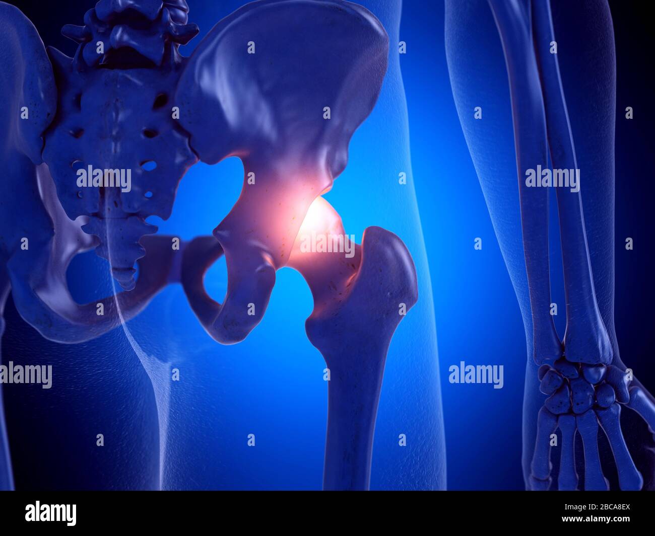 Hip infection hi-res stock photography and images - Alamy