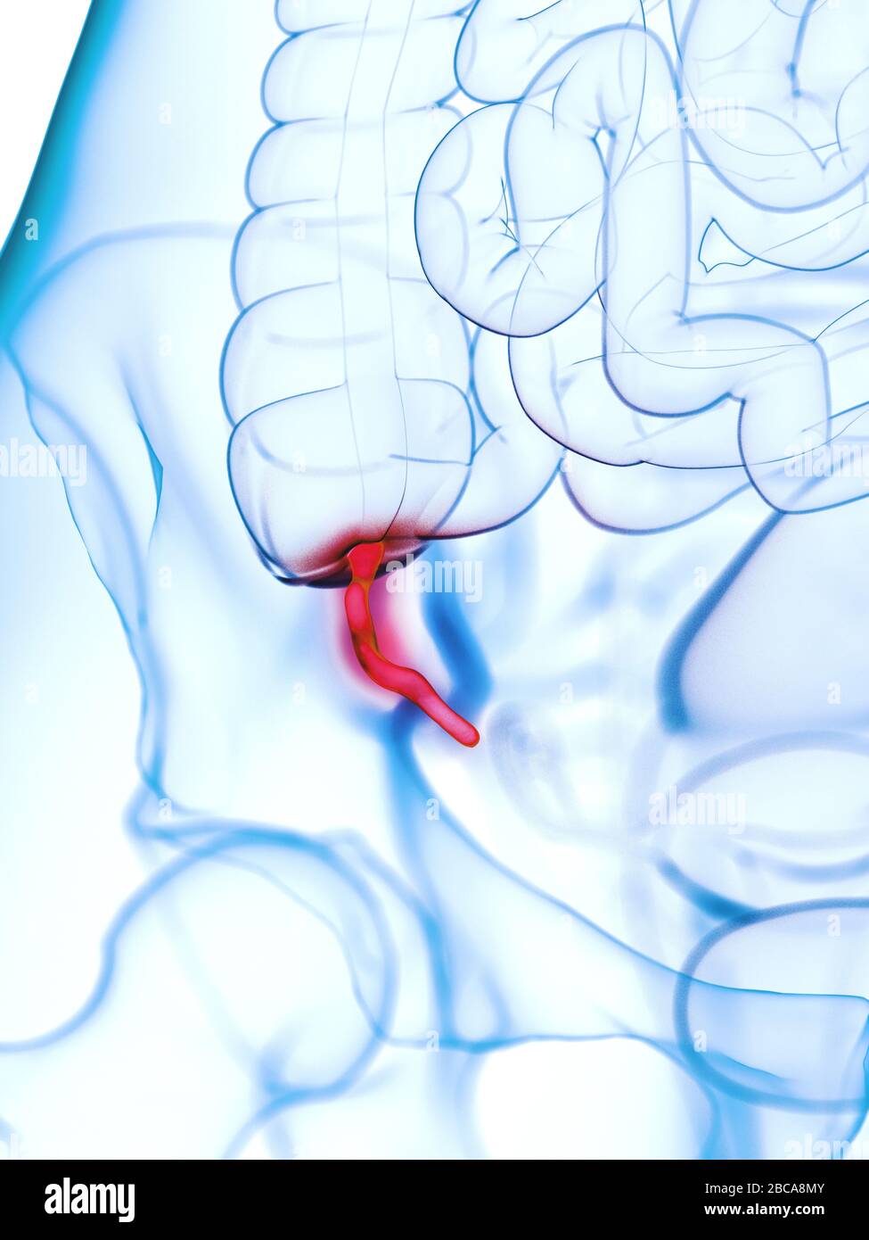 Inflamed appendix, illustration Stock Photo - Alamy