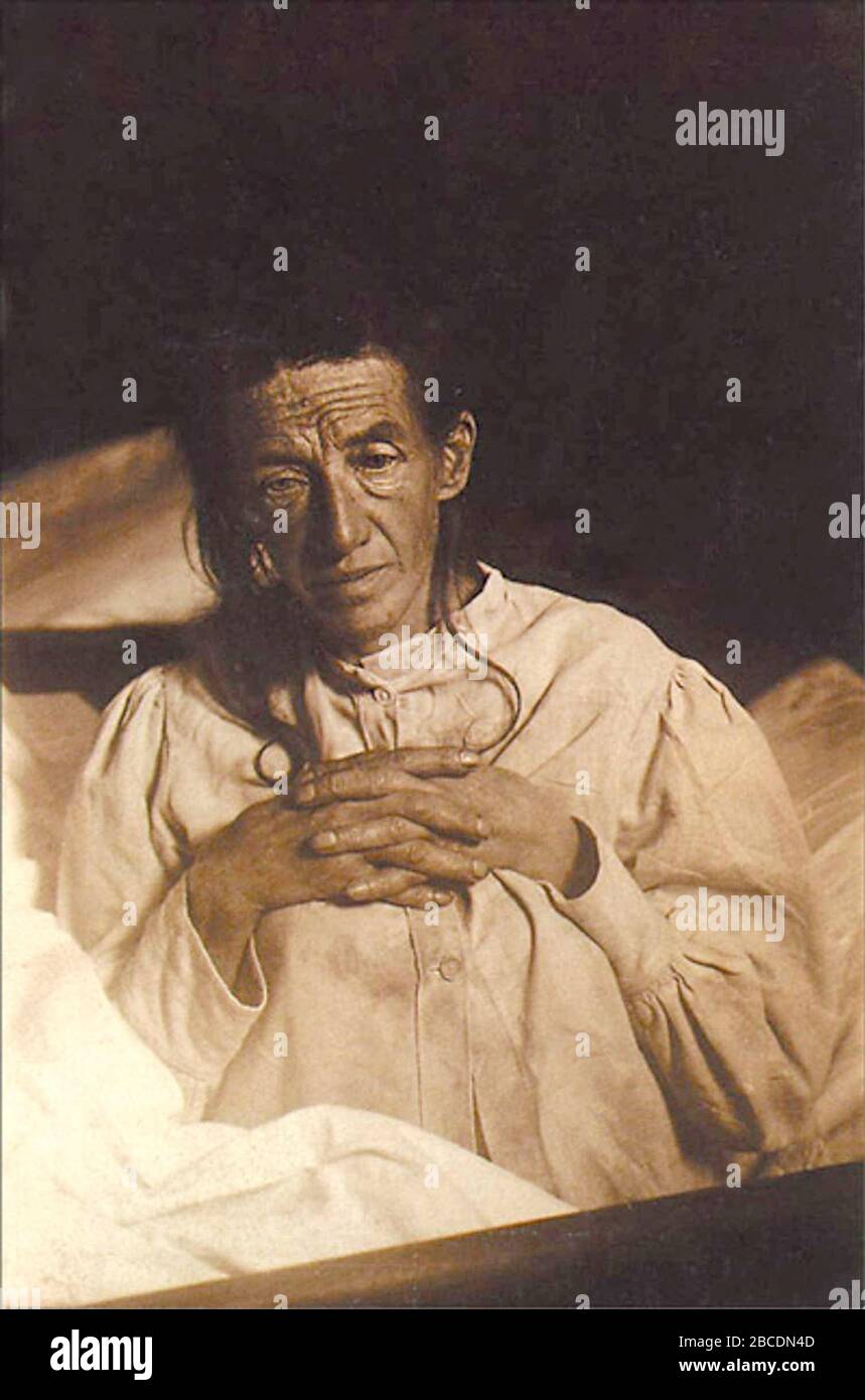 Auguste Deter (1850 – 1906) German woman notable for being the first person to be diagnosed with Alzheimer's disease. Alois Alzheimer's patient in November 1901, first described patient with Alzheimer's Disease. Stock Photo