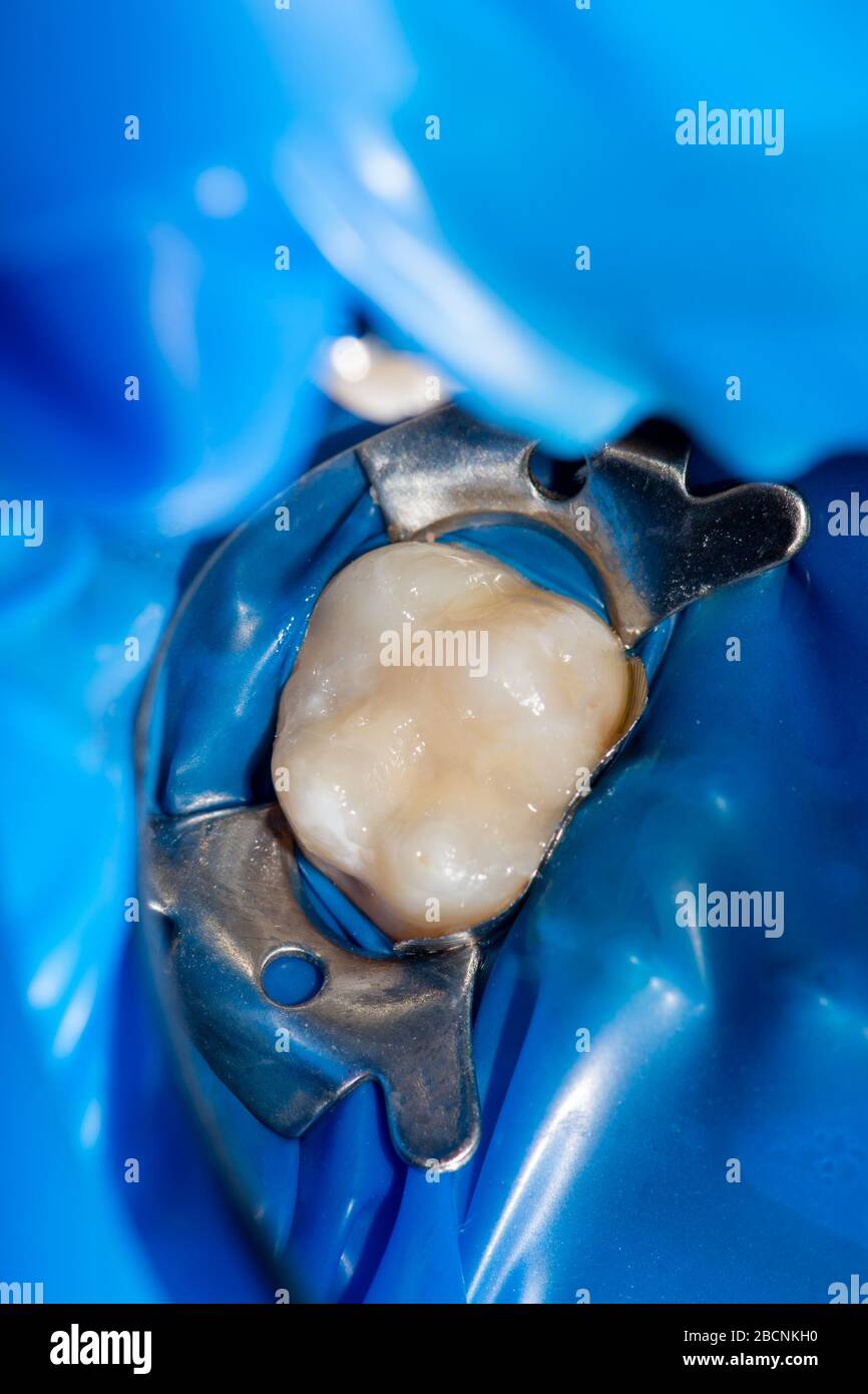 closeup treatment of a human tooth using blue rabberdam system and a