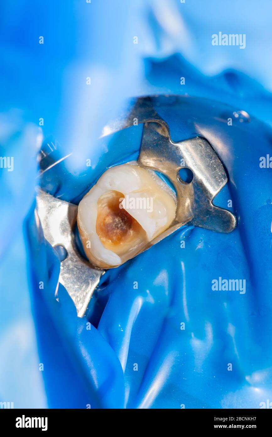 closeup treatment of a human tooth using blue rabberdam system and a