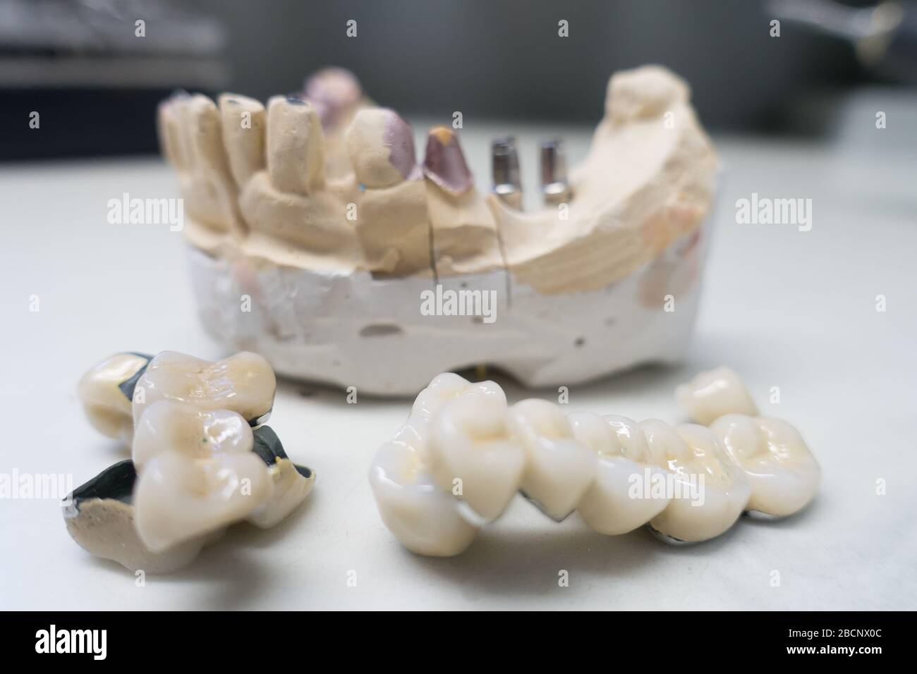 gypsum model of the human jaw with dental implants Stock Photo Alamy