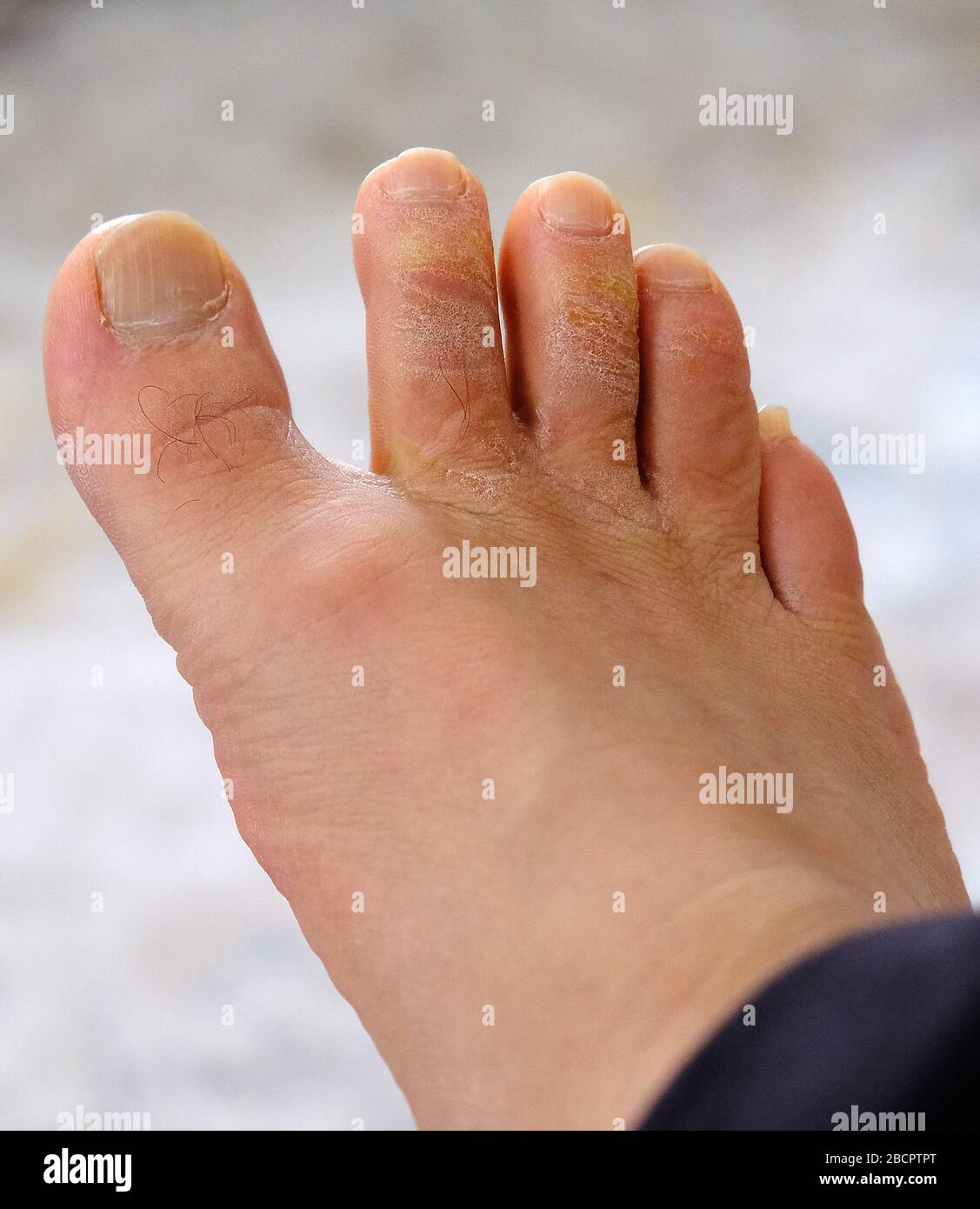 fungal disease on the toes, fungus formation on the toes, human foot