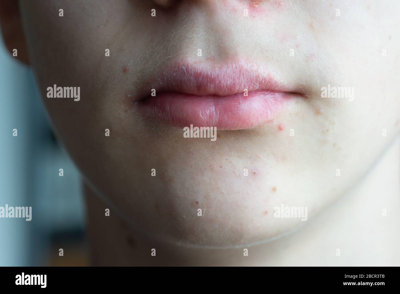 teenage boy withachné spots and dry lips.close up.skin care. Stock Photo