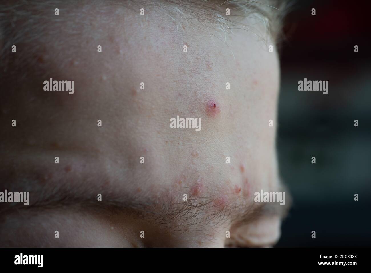 teenage boy with acné spots on forehead close up..skin care. Stock Photo