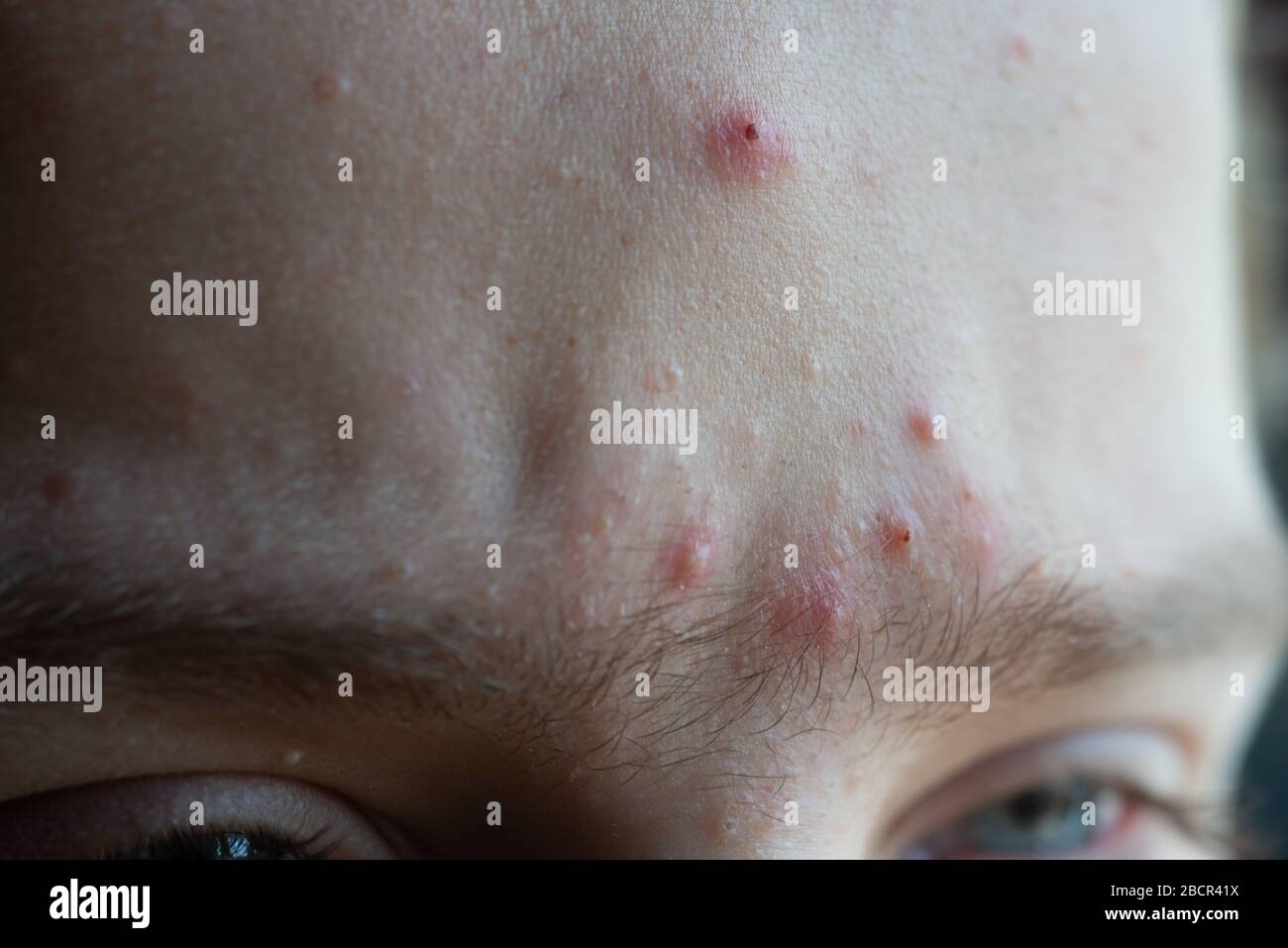 teenage boy with acné spots on forehead close up..skin care. Stock Photo
